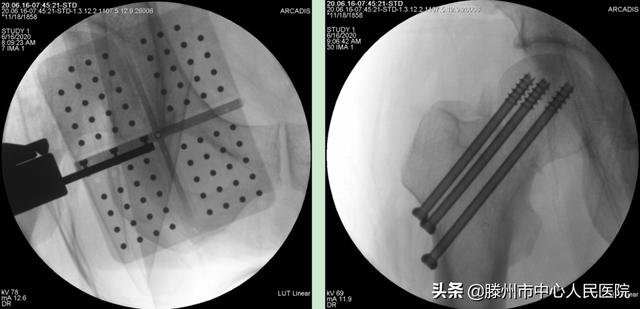 滕州市中心人民醫院成功完成骨科機器人手術