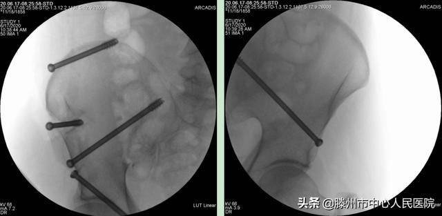 滕州市中心人民醫院成功完成骨科機器人手術