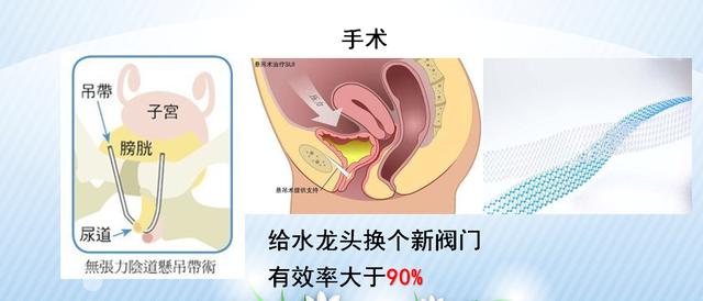 咳嗽、大笑……滴滴答答的尷尬，關(guān)于尿失禁的那些事