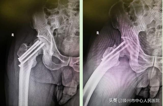 滕州市中心人民醫院成功完成骨科機器人手術