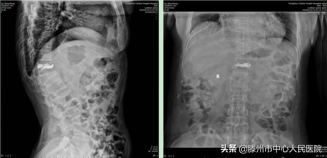 滕州市中心人民醫院成功完成骨科機器人手術