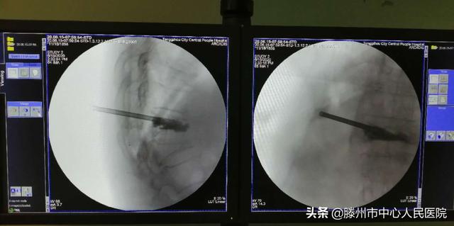 滕州市中心人民醫院成功完成骨科機器人手術