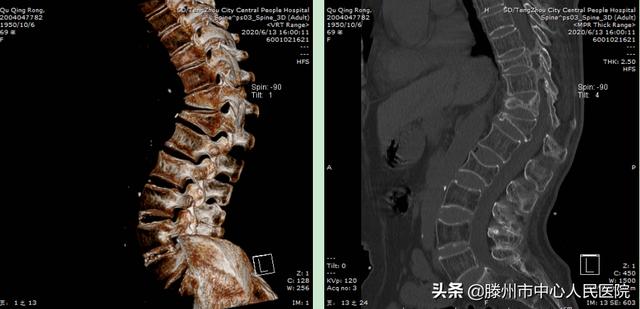 滕州市中心人民醫院成功完成骨科機器人手術