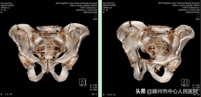 滕州市中心人民醫院成功完成骨科機器人手術